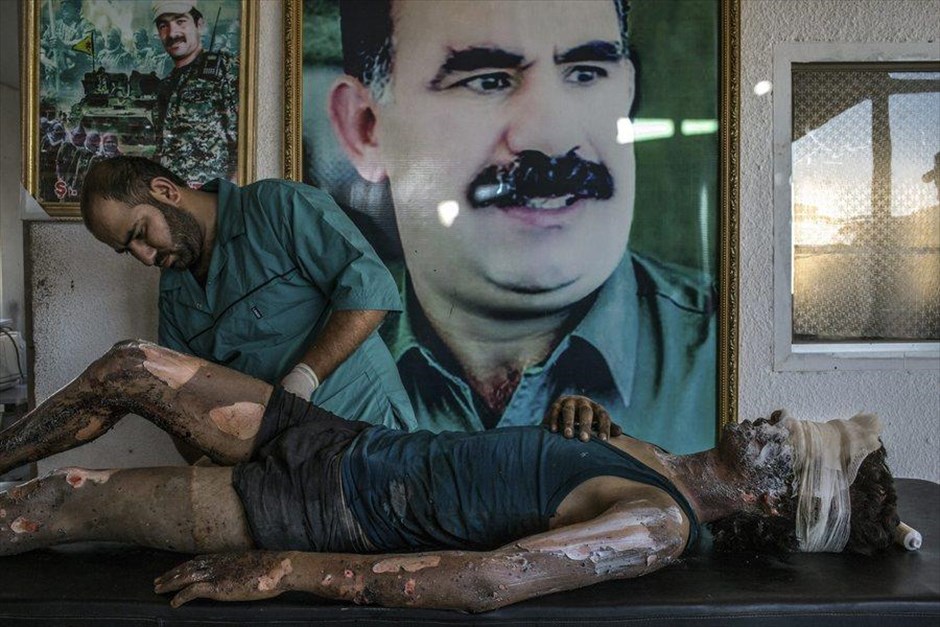 Βραβεία World Press Photo 2016. Ο Βραζιλιάνος φωτογράφος Mauricio Lima τιμήθηκε με το πρώτο βραβείο στην κατηγορία «General News» για την παραπάνω φωτογραφία, στην οποία απεικονίζεται ένας γιατρός να περιποιείται τα εγκαύματα ενός 16χρονου μαχητή του Ισλαμικού Κρατους σε νοσοκομείο του Κυβερνείου Αλ Χασακά, στη Συρία, στις 18 Φεβρουαρίου 2015.