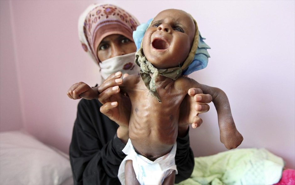 Η UNICEF για τον παιδικό υποσιτισμό στην Υεμένη. Μια μητέρα κρατά το υποσιτισμένο παιδί της σε ιατρικό κέντρο στη Σαναά. Το Ταμείο των Ηνωμένων Εθνών για τα Παιδιά δήλωσε τη Δευτέρα πως το 57% των 12 εκατομμυρίων παιδιών στην Υεμένη πάσχουν από χρόνιο υποσιτισμό, το υψηλότερο επίπεδο σε χώρα μετά τον πόλεμο στο Αφγανιστάν.