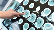 «Εκκίνηση» εγκεφάλου ασθενούς σε κώμα με υπερήχους