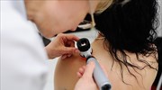 Τεχνητή νοημοσύνη ικανή να αναγνωρίζει τον καρκίνο του δέρματος με μια «ματιά»