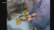 Βατικανό: Συνέδριο για την καταπολέμηση του εμπορίου ανθρωπίνων οργάνων