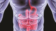 Μια νέα βιολογική θεραπεία για τη νόσο του Crohn είναι γεγονός