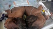 Σ. Αραβία: Σιαμαίες αδελφές από την Παλαιστίνη διαχωρίστηκαν με επιτυχία