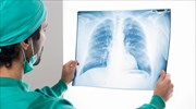 «Φοράμε λευκό»: Καμπάνια ευαισθητοποίησης για τον καρκίνο του πνεύμονα