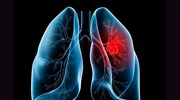 Επιστημονική Διημερίδα για τον Καρκίνο  του Πνεύμονα: «Η Αναπνοή μας, Η Ζωή μας»