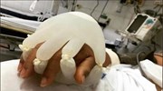 Βραζιλία: Τα γάντια που μιμούνται το ανθρώπινο άγγιγμα, βάλσαμο για τους ασθενείς με κορωνοϊό