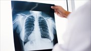 Καρκίνος του Πνεύμονα: Μείωση  θανάτων κατά 25% αν εφαρμοστεί ο προσυμπτωματικός έλεγχος