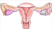 Ποια ποιοτικά κριτήρια πρέπει να πληρεί ο Γυναικολόγος Ογκολόγος που αντιμετωπίζει καρκίνο του ενδομητρίου;