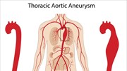 Διακαθετηριακή αντιμετώπιση ανευρυσμάτων