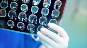 Προχωρά η μελέτη διάγνωσης εγκεφαλικών όγκων - Πώς θα γίνεται η εξέταση
