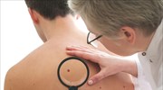 Καρκίνος του δέρματος: Από κάποια μορφή πάσχουν περίπου 7,3 εκατ. Ευρωπαίοι - Πώς προκαλείται