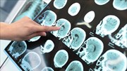 Μαγνητική τομογραφία τεχνητής νοημοσύνης εντοπίζει νωρίς τη νόσο Αλτσχάιμερ