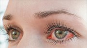 Ευλογιά των πιθήκων: Πώς μπορεί να επηρεάσει τα μάτια και την όραση