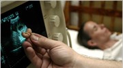 Μείωση του αριθμού των αμβλώσεων παγκοσμίως