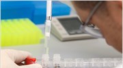 Πέντε νέα γονίδια «ένοχα» για τη νόσο του Πάρκισον