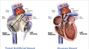 Υβριδική «cyborg» καρδιά