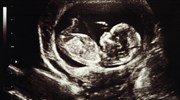Αριζόνα: Οριστικά άκυρος ο νόμος που απαγορεύει τις εκτρώσεις